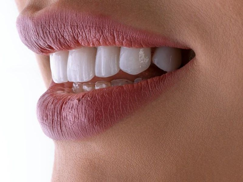Smile before whitening (illustration)